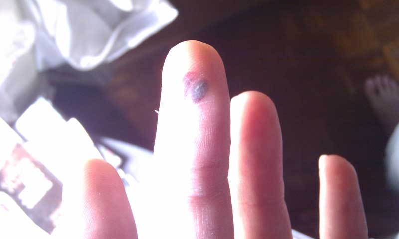 Injured my finger during ICT